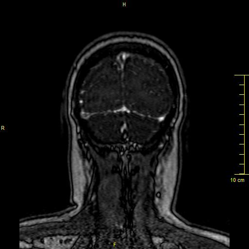 Cerebral venous thrombosis (Radiopaedia 23288-23351 MRV 158).JPG