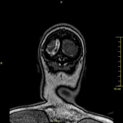 Cerebral venous thrombosis (Radiopaedia 23288-23351 MRV 174).JPG