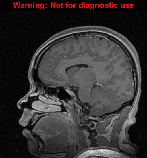 Cerebral venous thrombosis (Radiopaedia 37224-39208 Sagittal T1 C+ 68).jpg