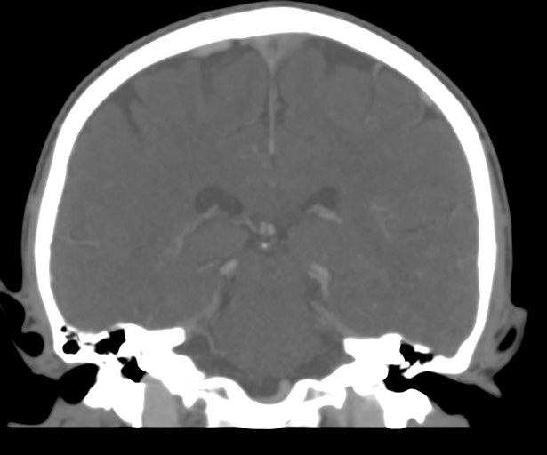 File:Cerebral venous thrombosis (Radiopaedia 38392-40467 Coronal CTA-Venogram 38).png