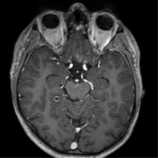 Cerebral venous thrombosis (Radiopaedia 38392-40469 Axial T1 C+ 32).png