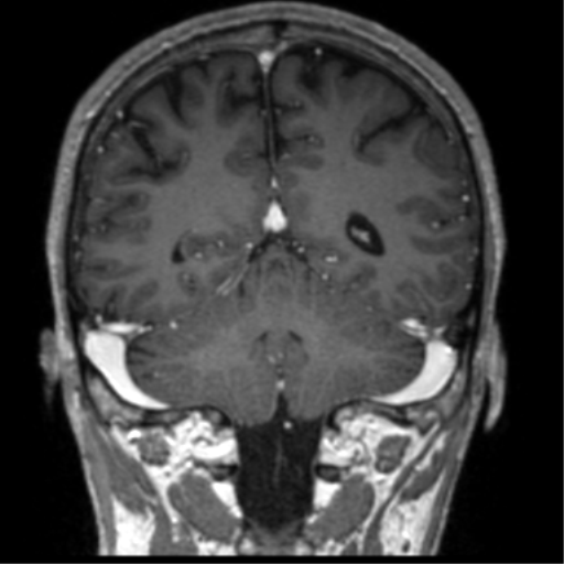 Cerebral venous thrombosis (Radiopaedia 38392-40469 Coronal T1 C+ 28).png