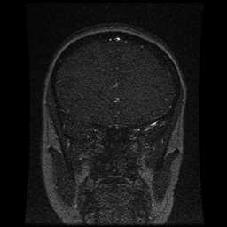 Cerebral venous thrombosis - ulcerative colitis (Radiopaedia 66049-75219 Coronal MRV 83).jpg