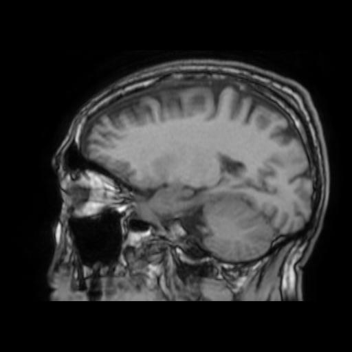 File:Cerebral venous thrombosis with secondary intracranial hypertension (Radiopaedia 89842-106957 Sagittal T1 20).jpg