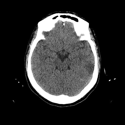 Cerebral venous thrombosis with venous hemorrhagic infarct (Radiopaedia 90354-107660 Axial non-contrast 20).jpg
