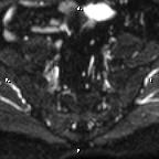 Cervical adenocarcinoma (Radiopaedia 65011-73985 Axial DWI 82).jpg