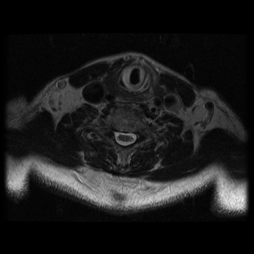File:Cervical canal stenosis with cord compression (Radiopaedia 34114-35374 Axial T2 16).png