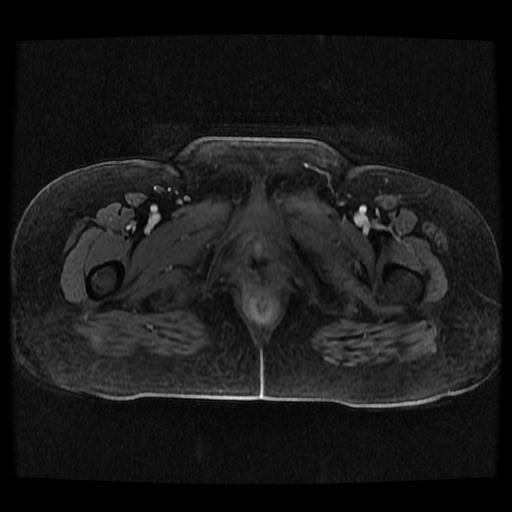 File:Cervical carcinoma (Radiopaedia 70924-81132 Axial T1 C+ fat sat 20).jpg
