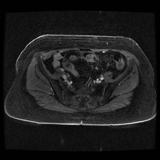 Cervical carcinoma (Radiopaedia 70924-81132 Axial T1 C+ fat sat 244).jpg