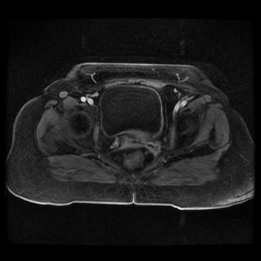 Cervical carcinoma (Radiopaedia 70924-81132 Axial T1 C+ fat sat 45).jpg