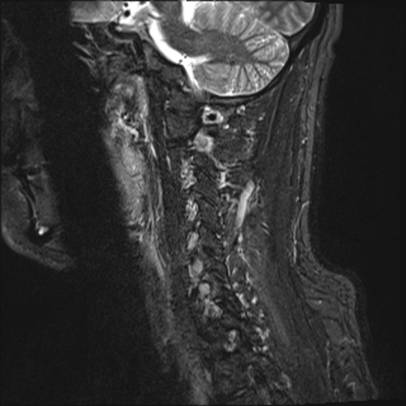 File:Cervical disc extrusion (Radiopaedia 53950-60077 Sagittal STIR 15).jpg