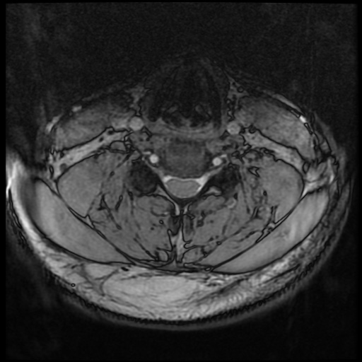 Cervical disc extrusion (Radiopaedia 59074-66364 G 54).jpg