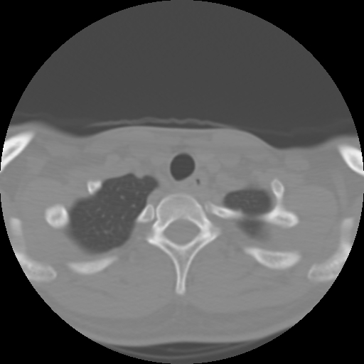 Cervical rib (Radiopaedia 71110-81363 Axial non-contrast 49).jpg