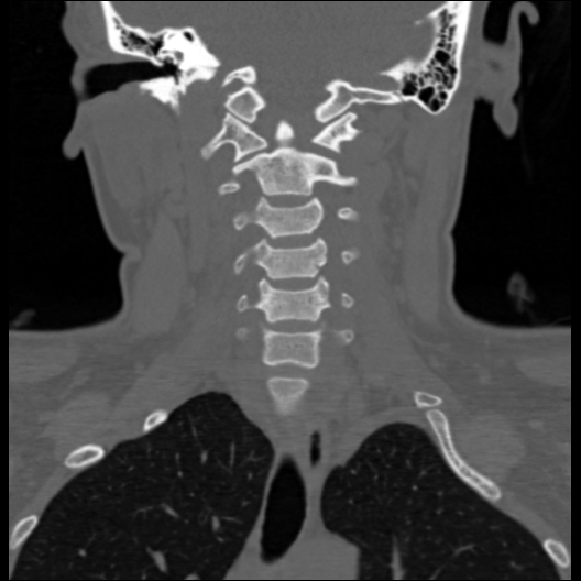 File:Cervical rib (Radiopaedia 71110-81363 Coronal non-contrast 27).jpg