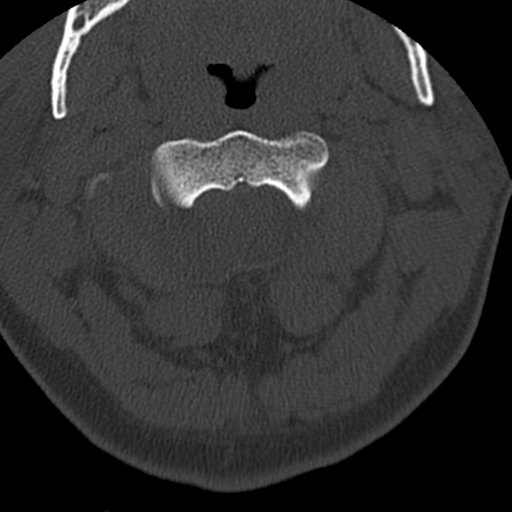 File:Cervical schwannoma (Radiopaedia 57979-64974 Axial bone window 14).png