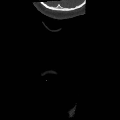 Cervical schwannoma (Radiopaedia 57979-64974 Coronal bone window 72).png