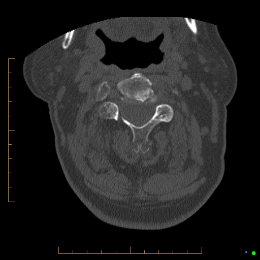 File:Cervical spine fracture - ankylosing spondylitis (Radiopaedia 76835-88706 Axial bone window 71).jpg
