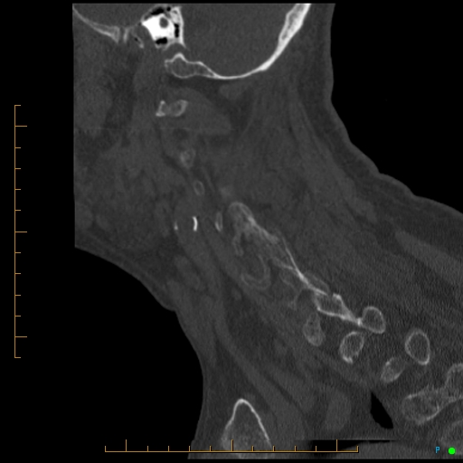 File:Cervical spine fracture - ankylosing spondylitis (Radiopaedia 76835-88706 Sagittal bone window 31).jpg