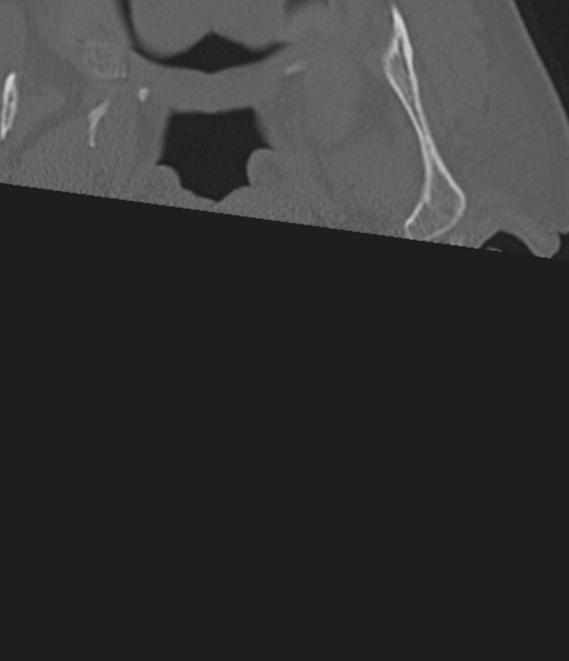 Cervical spine fracture in the setting of ankylosis (Radiopaedia 37038-38715 Axial bone window 2).png