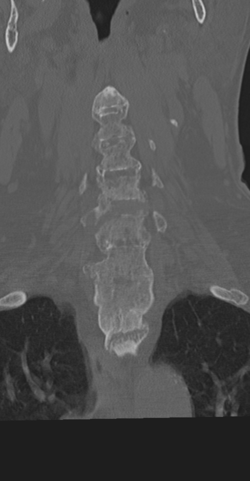 Cervical spine fracture in the setting of ankylosis (Radiopaedia 37038-38715 Coronal bone window 24).png