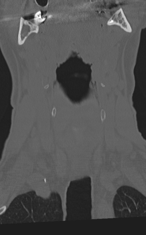 Cervical spine fractures with vertebral artery dissection (Radiopaedia 53296-59268 Coronal bone window 13).png
