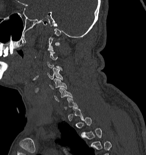 File:Cervical spine trauma with tear drop fracture and perched facet joint (Radiopaedia 53989-60127 Sagittal bone window 26).jpg