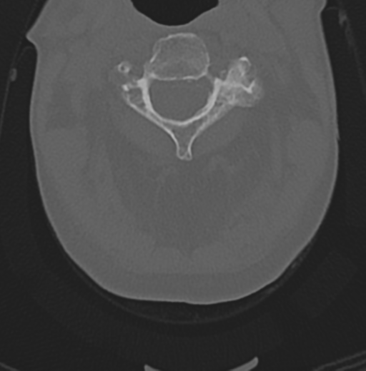 File:Cervical spondylolysis (Radiopaedia 49616-54811 Axial bone window 18).png