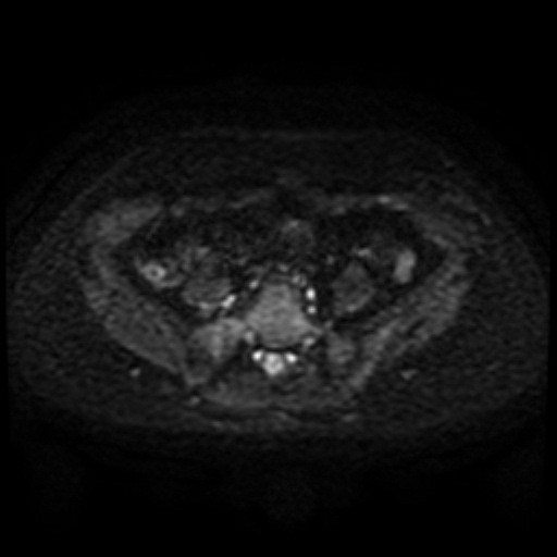 Cesarian section scar endometriosis (Radiopaedia 66520-75799 Axial DWI 27).jpg