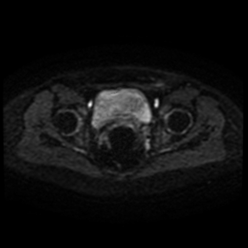 File:Cesarian section scar endometriosis (Radiopaedia 66520-75799 Axial DWI 42).jpg