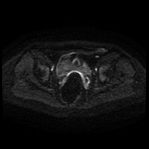 Cesarian section scar endometriosis (Radiopaedia 66520-75799 Axial DWI 65).jpg