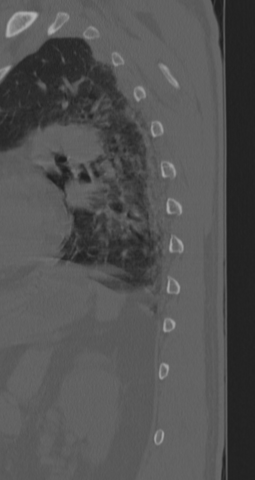 Chance fracture (Radiopaedia 33854-35020 Sagittal bone window 14).png