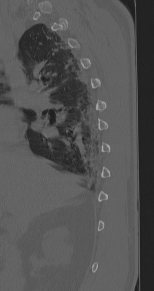Chance fracture (Radiopaedia 33854-35020 Sagittal bone window 69).png