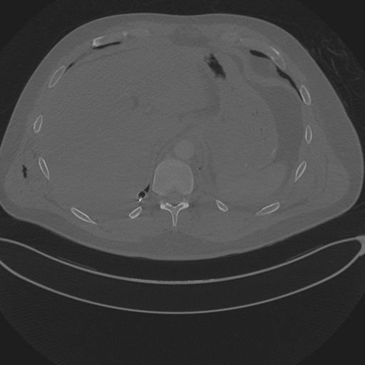 Chest multitrauma - aortic injury (Radiopaedia 34708-36147 Axial bone window 266).png