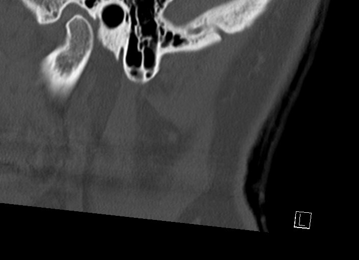 Chiari I malformation with a symptomatic syrinx of the posterolateral medulla oblongata (Radiopaedia 42573-45707 A 58).jpg