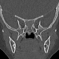 Choanal atresia (Radiopaedia 88525-105975 Coronal bone window 82).jpg
