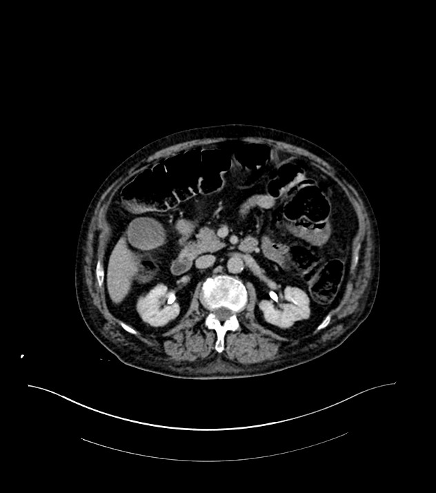 Cholangiocarcinoma with cerebral metastases (Radiopaedia 83519-98629 Axial C+ delayed 45).jpg