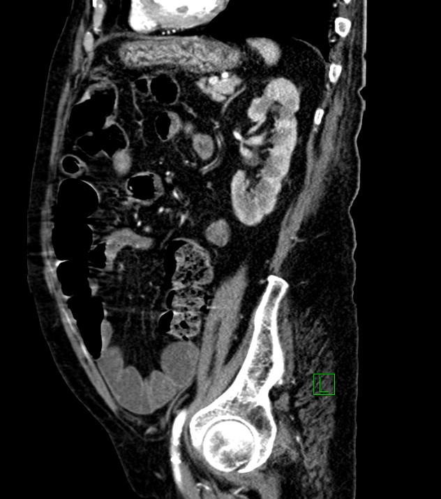 Cholangiocarcinoma with cerebral metastases (Radiopaedia 83519-98629 F 41).jpg