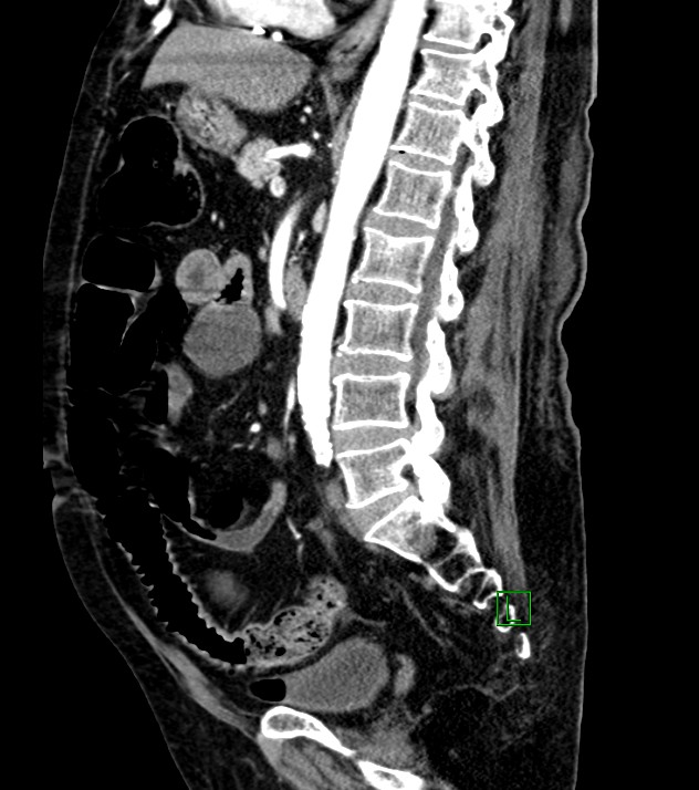 Cholangiocarcinoma with cerebral metastases (Radiopaedia 83519-98629 F 58).jpg