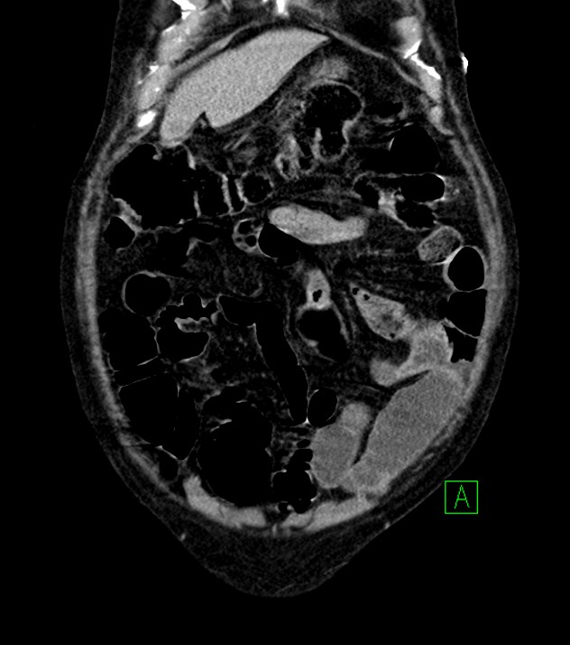 Cholangiocarcinoma with cerebral metastases (Radiopaedia 83519-98629 G 15).jpg