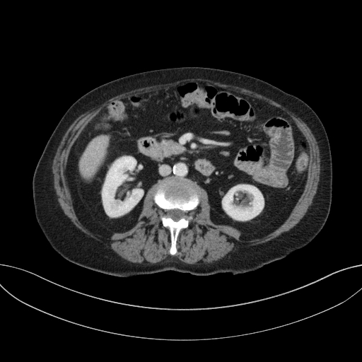 Cholecystoduodenal fistula due to calculous cholecystitis with gallstone migration (Radiopaedia 86875-103077 D 39).jpg