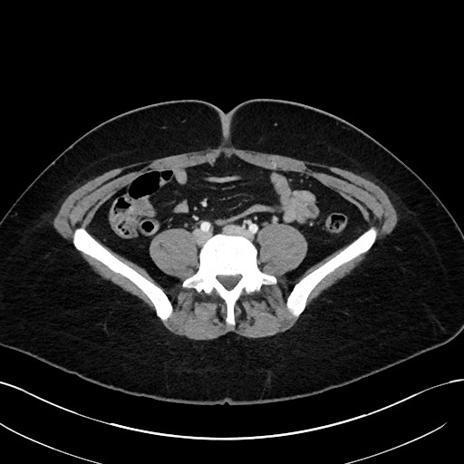 File:Choledocholithiasis after recent cholecystectomy (Radiopaedia 60929-68737 Axial 16).jpg