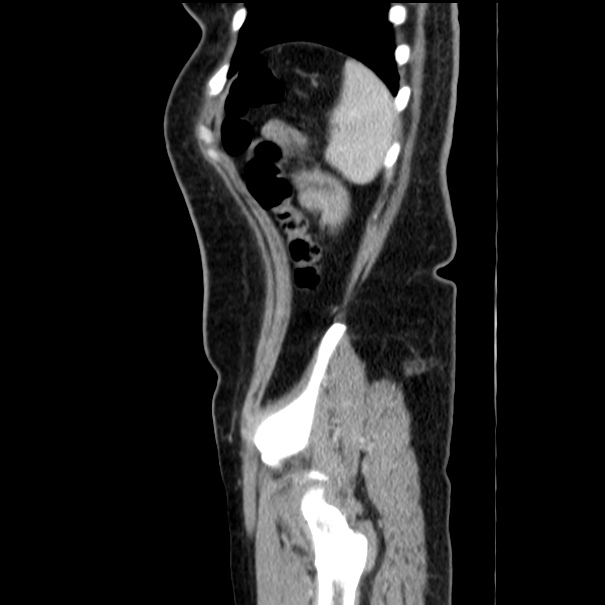 Choledocholithiasis on CT and MRI (Radiopaedia 24825-25087 D 55).jpg