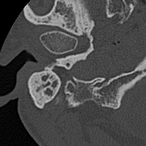 File:Cholesteatoma (Radiopaedia 15846-15494 bone window 30).jpg