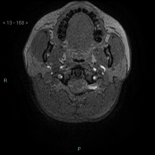 File:Cholesterol granuloma of the petrous apex (Radiopaedia 64358-73140 Axial TOF 3D 81).jpg