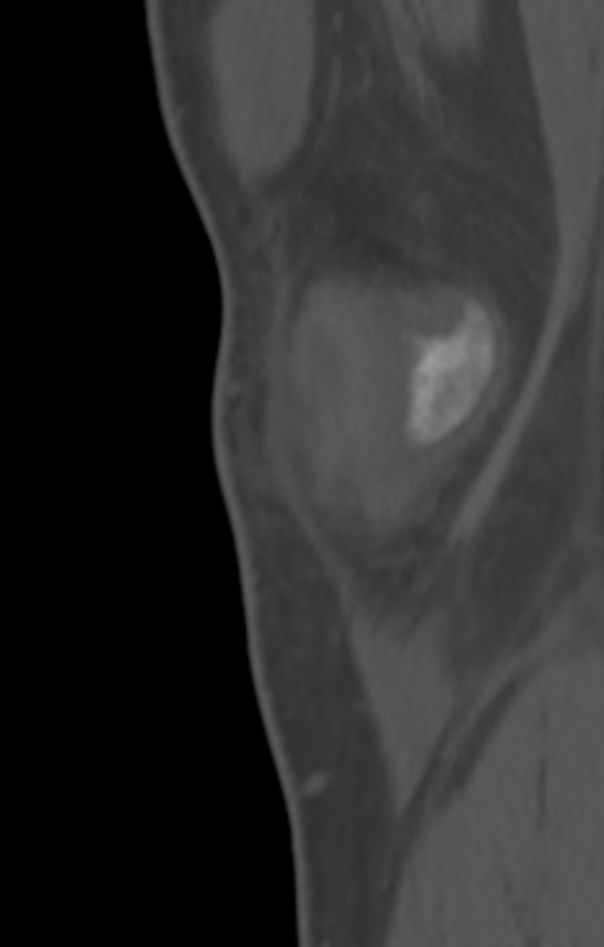 Chondrocalcinosis (Radiopaedia 82862-97173 Sagittal bone window 1).jpg