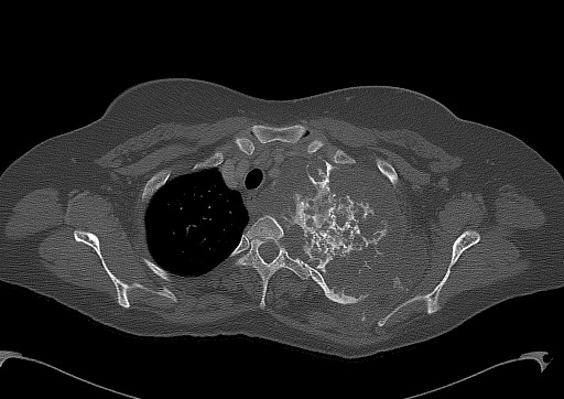 File:Chondrosarcoma - chest wall (Radiopaedia 65192-74199 Axial bone window 26).jpg