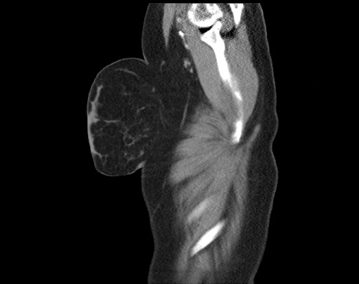 Chondrosarcoma - chest wall (Radiopaedia 65192-74199 B 56).jpg