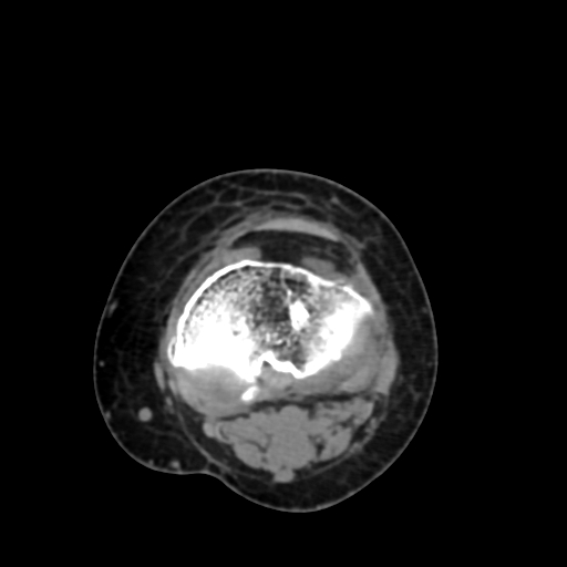 Chondrosarcoma - femur (Radiopaedia 64187-72954 Axial non-contrast 60).jpg
