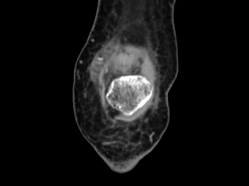 Chondrosarcoma - femur (Radiopaedia 64187-72954 C 7).jpg
