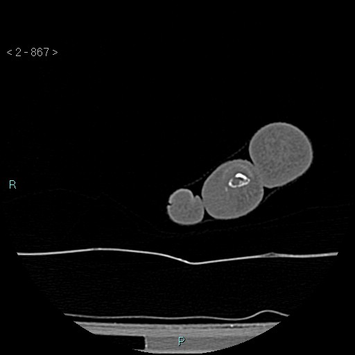 Chondrosarcoma - phalanx (Radiopaedia 69047-78812 Axial bone window 121).jpg